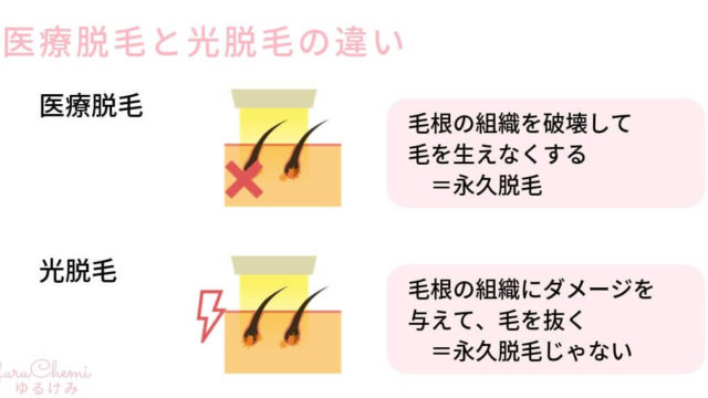 脱毛原理：医療脱毛と光脱毛の違い